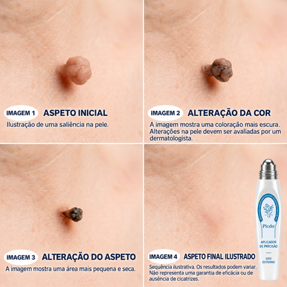 🧶🐍𝐏i𝐜𝐝o® Eliminador de Marcas e Manchas em 7 Dias (Roll-on Sem Dor e Sem Cicatrizes)