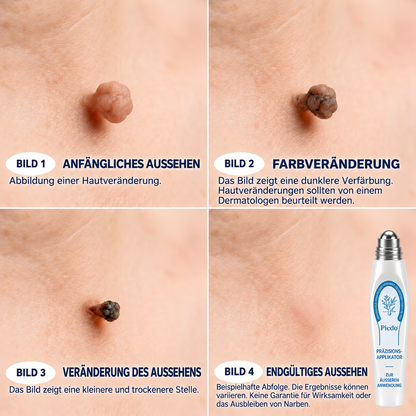 🧶🧶𝐏i𝐜𝐝o® 7-Tage-Entferner für Hautmale und Hautflecken (Schmerzfreier Roll-on ohne Narbenbildung)