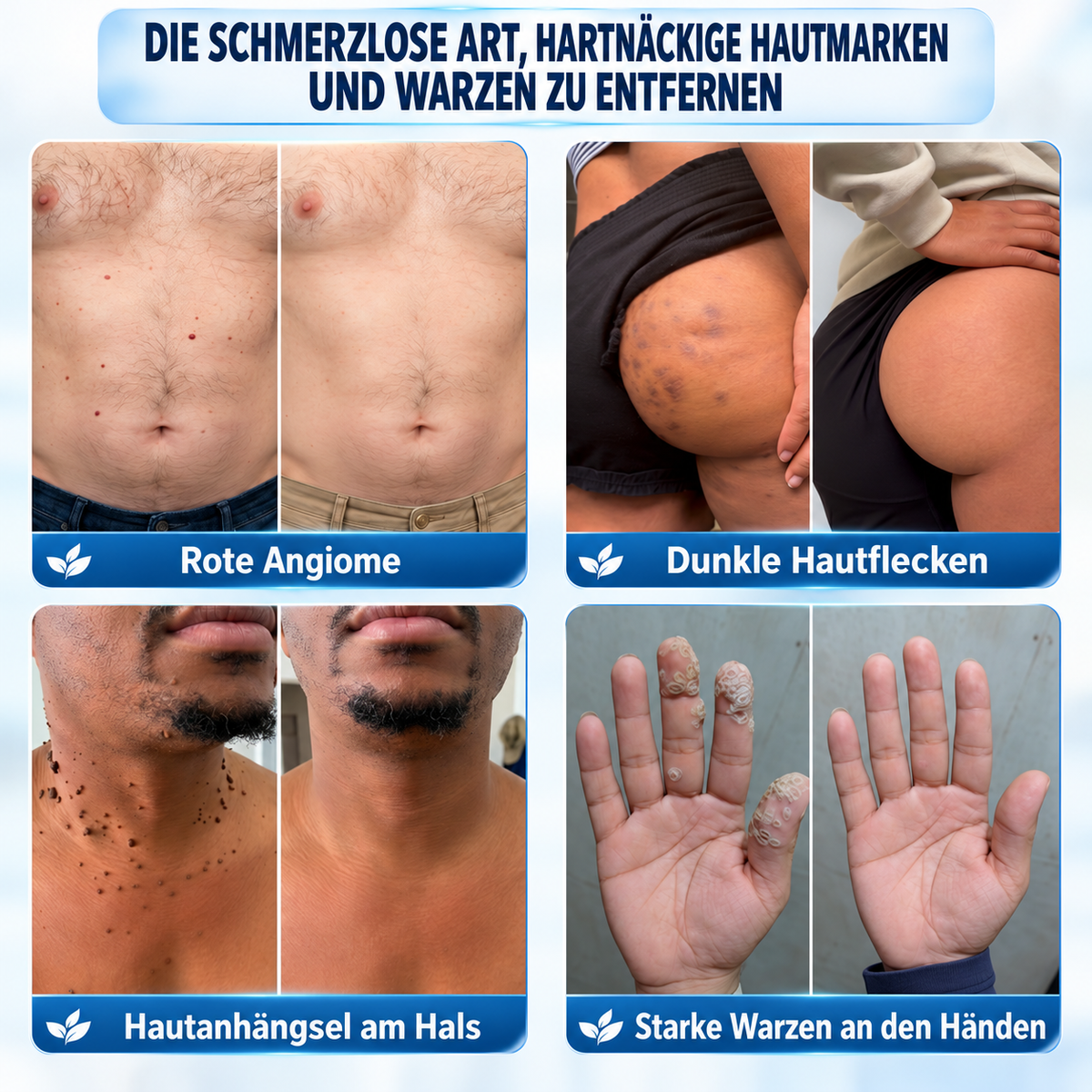 🧶🧶𝐏i𝐜𝐝o® 7-Tage-Entferner für Hautmale und Hautflecken (Schmerzfreier Roll-on ohne Narbenbildung)