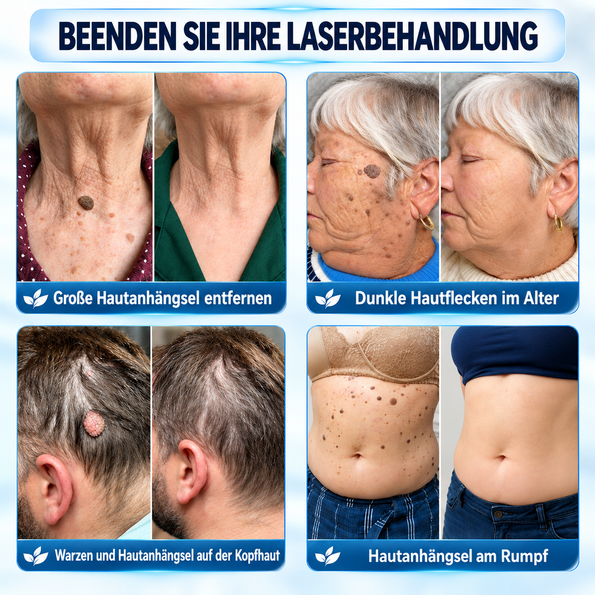 🧶🧶𝐏i𝐜𝐝o® 7-Tage-Entferner für Hautmale und Hautflecken (Schmerzfreier Roll-on ohne Narbenbildung)