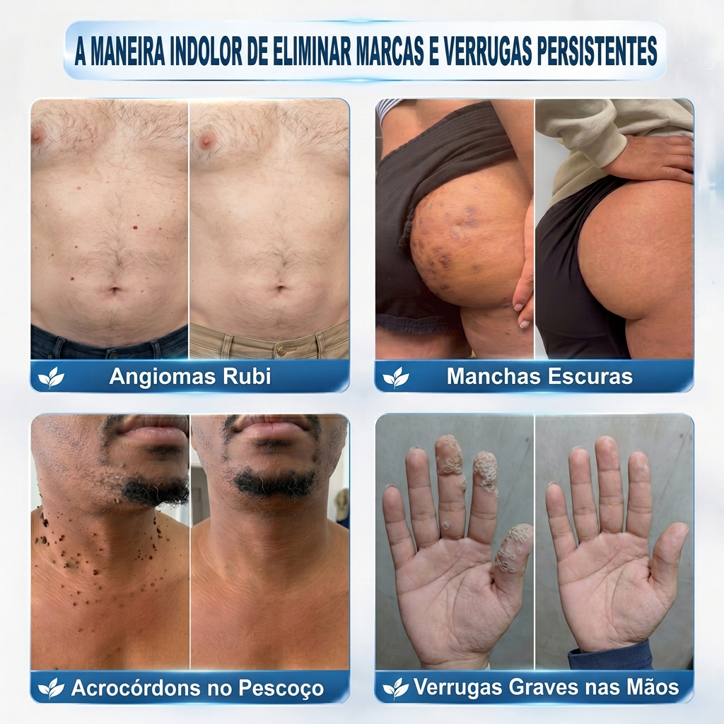 🧶🐍𝐏i𝐜𝐝o® Eliminador de Marcas e Manchas em 7 Dias (Roll-on Sem Dor e Sem Cicatrizes)