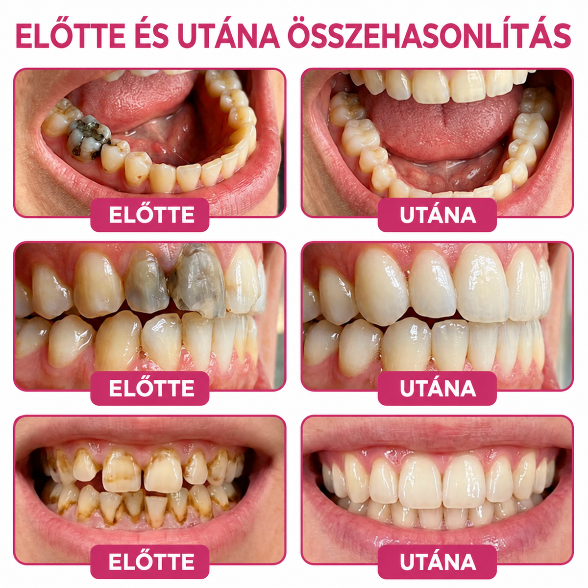 1️⃣𝐇𝐄𝐀𝐓𝐖𝐎𝐋𝐅® Természetes fogzománc-helyreállító gél