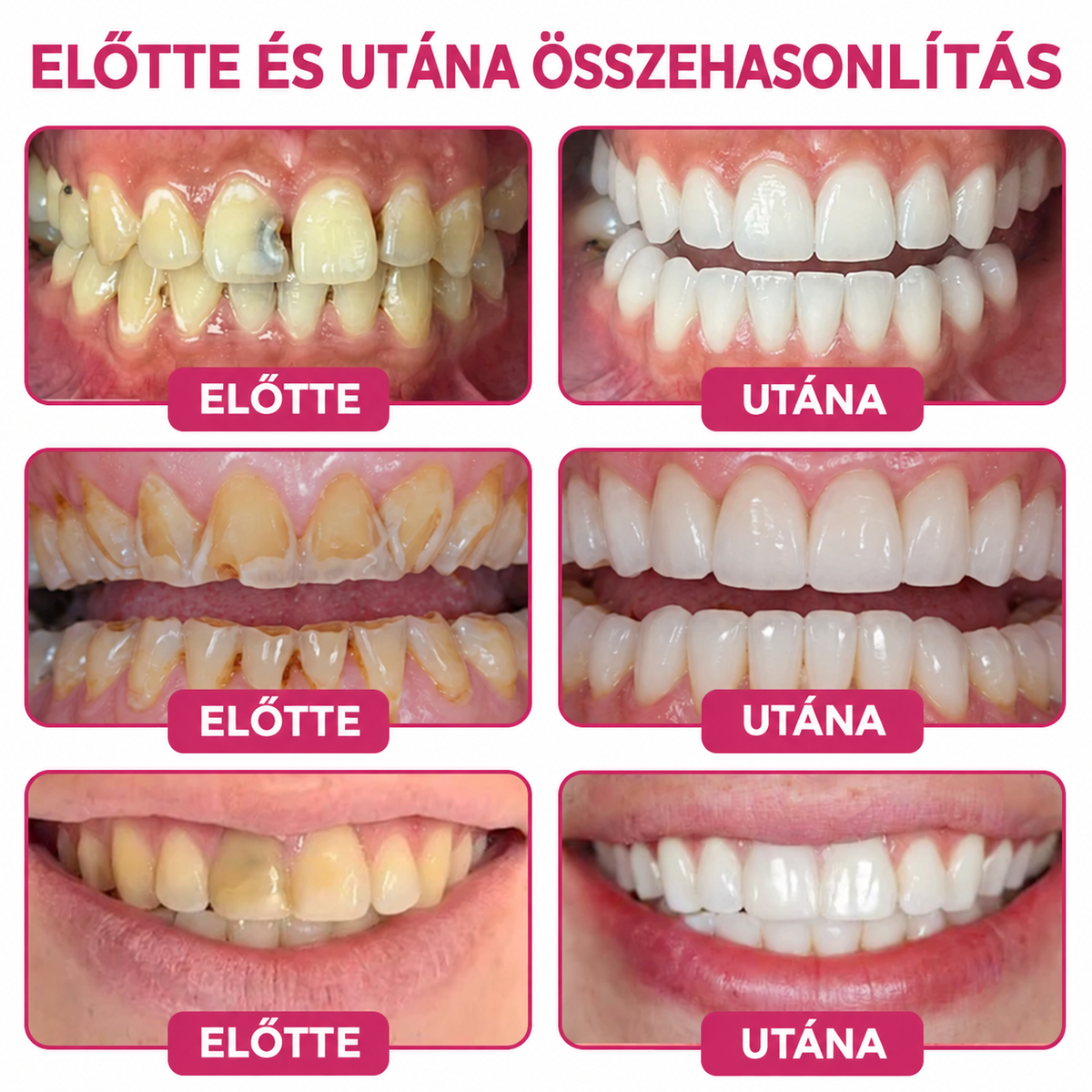 1️⃣𝐇𝐄𝐀𝐓𝐖𝐎𝐋𝐅® Természetes fogzománc-helyreállító gél
